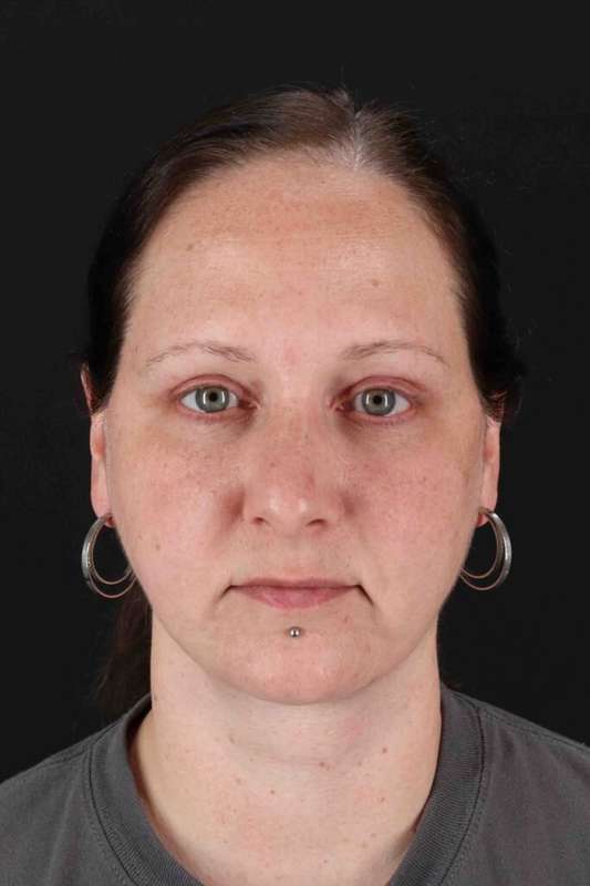 Facelift Before & After Patient #5273