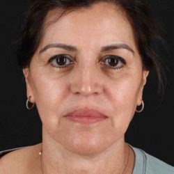 Facelift Before & After Patient #5284