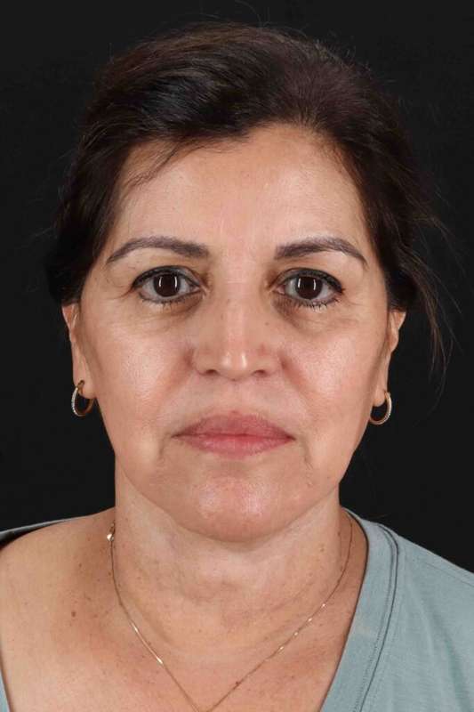Facelift Before & After Patient #5284