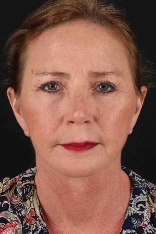 Facelift Before & After Patient #5295