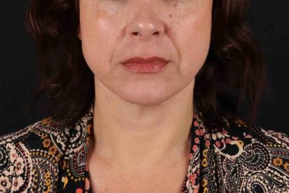 Facelift Before & After Patient #5315