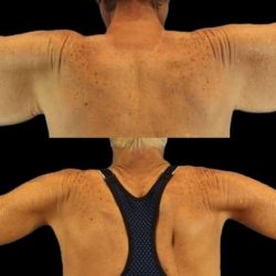 Brachioplasty (Arm Lift) Before & After Patient #1121