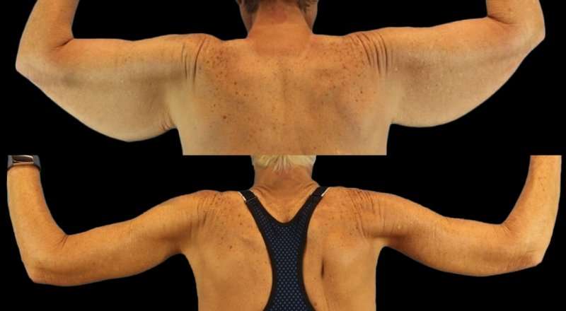 Brachioplasty (Arm Lift) Before & After Patient #1121
