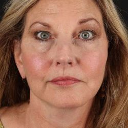 Facelift Before & After Patient #5348