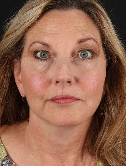 Facelift Before & After Patient #5348
