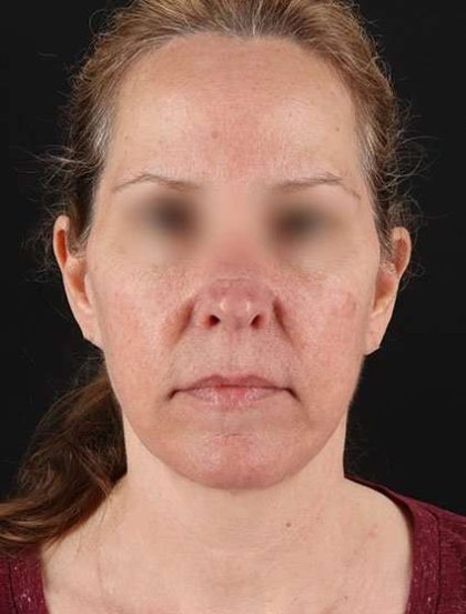 Facelift Before & After Patient #5359