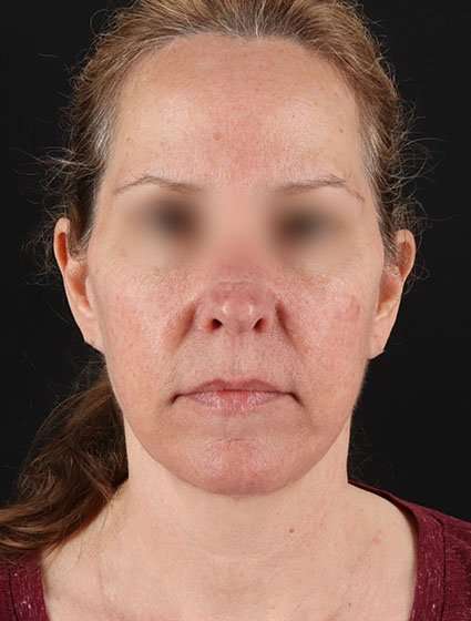 Facelift Before & After Patient #5359