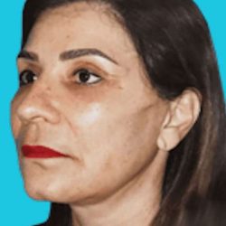 Facelift Before & After Patient #5362