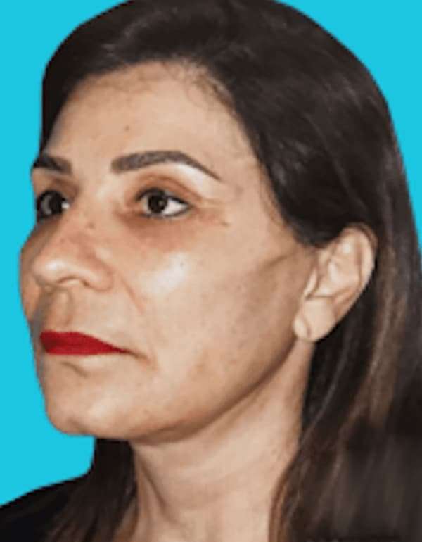 Facelift Before & After Patient #5362