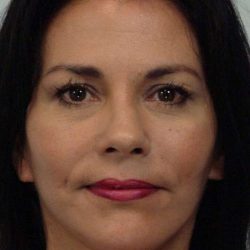 Facelift Before & After Patient #5367