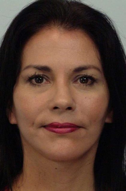 Facelift Before & After Patient #5367