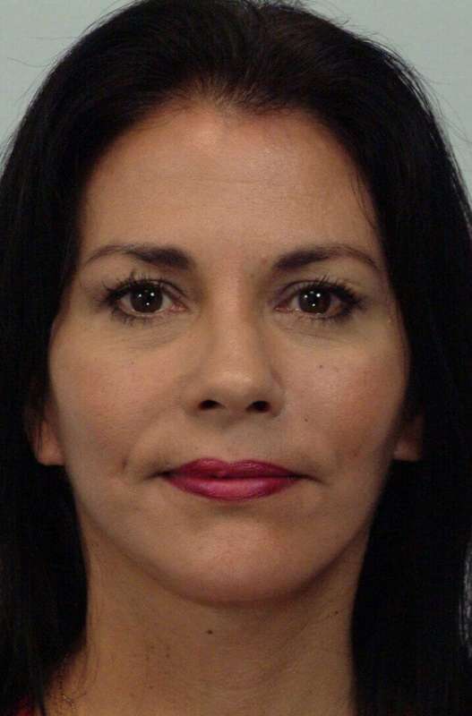 Facelift Before & After Patient #5367
