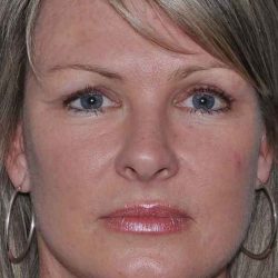 Facelift Before & After Patient #5385