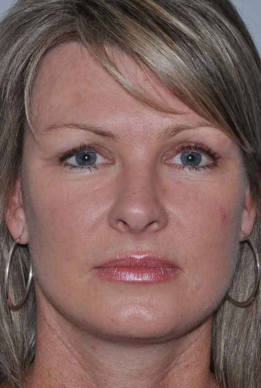 Facelift Before & After Patient #5385