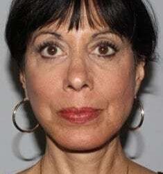 Facelift Before & After Patient #5399