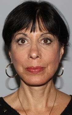 Facelift Before & After Patient #5399
