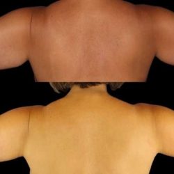 Brachioplasty (Arm Lift) Before & After Patient #1125