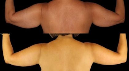 Brachioplasty (Arm Lift) Before & After Patient #1125