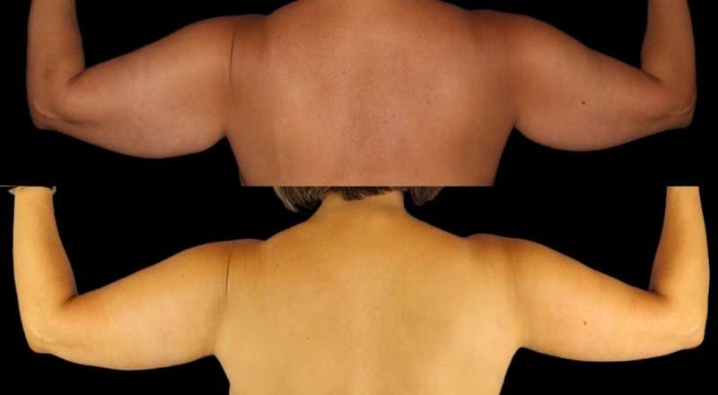 Brachioplasty (Arm Lift) Before & After Patient #1125