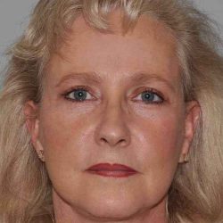 Facelift Before & After Patient #5424
