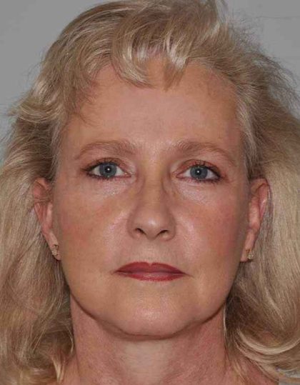 Facelift Before & After Patient #5424