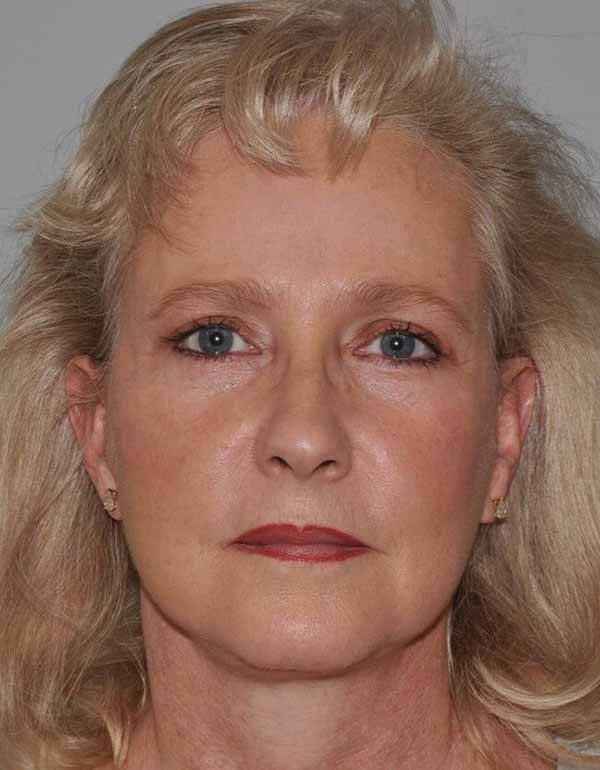 Facelift Before & After Patient #5424