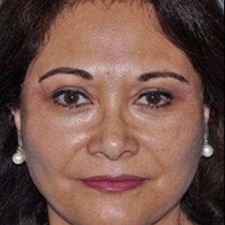 Facelift Before & After Patient #5438