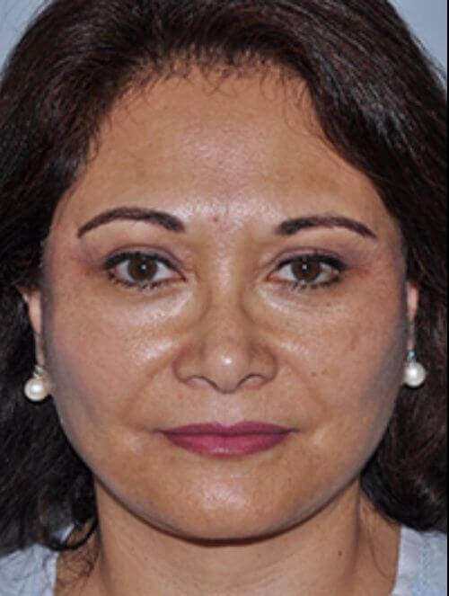 Facelift Before & After Patient #5438
