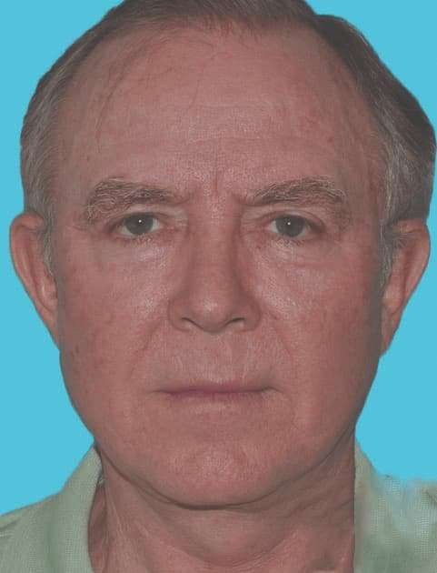 Facelift Before & After Patient #5459