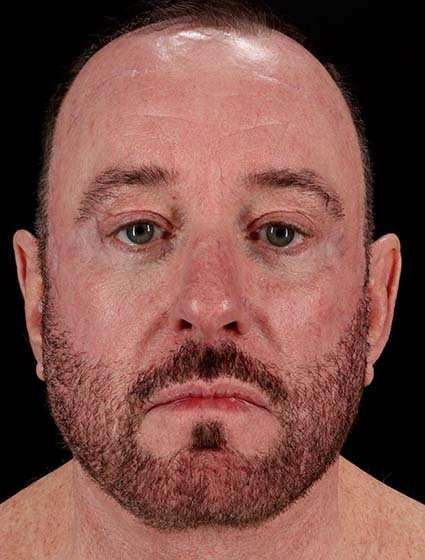 Facelift Before & After Patient #5477