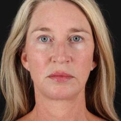 Facelift Before & After Patient #5488