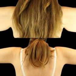 Brachioplasty (Arm Lift) Before & After Patient #1128
