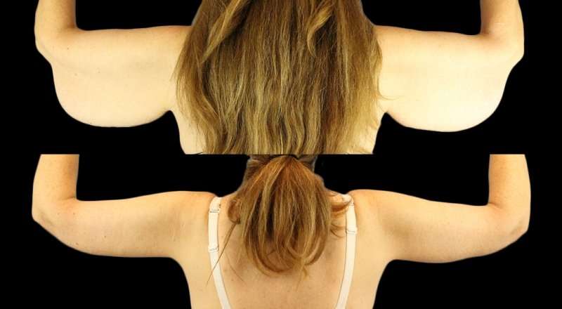 Brachioplasty (Arm Lift) Before & After Patient #1128