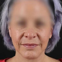 Facelift Before & After Patient #5499