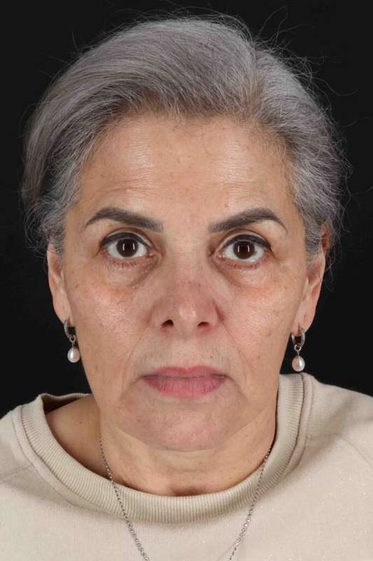 Facelift Before & After Patient #5510