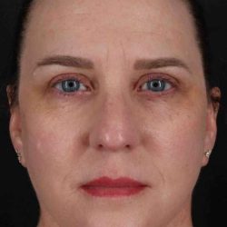 Facelift Before & After Patient #5521