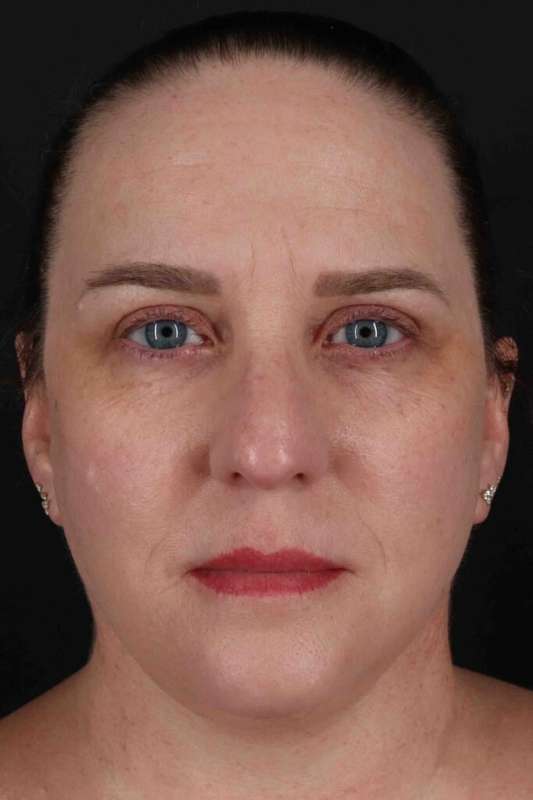 Facelift Before & After Patient #5521