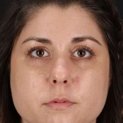 Chemical Peels Before & After Patient #5557