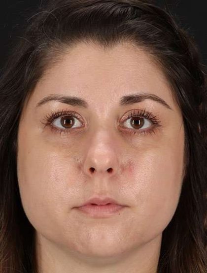 Chemical Peels Before & After Patient #5557