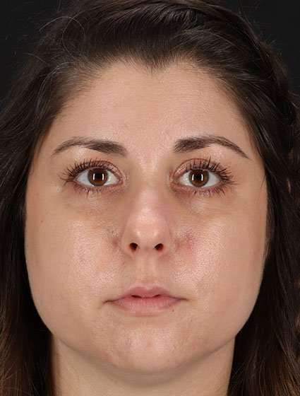 Chemical Peels Before & After Patient #5557