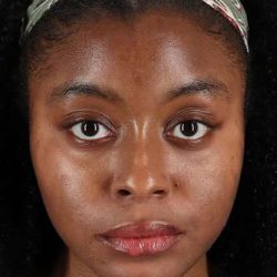 Chemical Peels Before & After Patient #5568