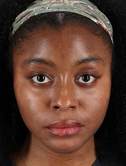 Chemical Peels Before & After Patient #5568