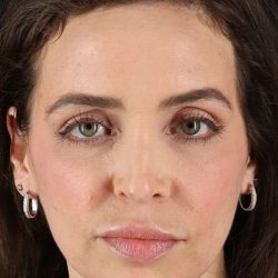 Chemical Peels Before & After Patient #5579