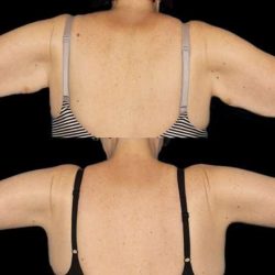 Brachioplasty (Arm Lift) Before & After Patient #1131