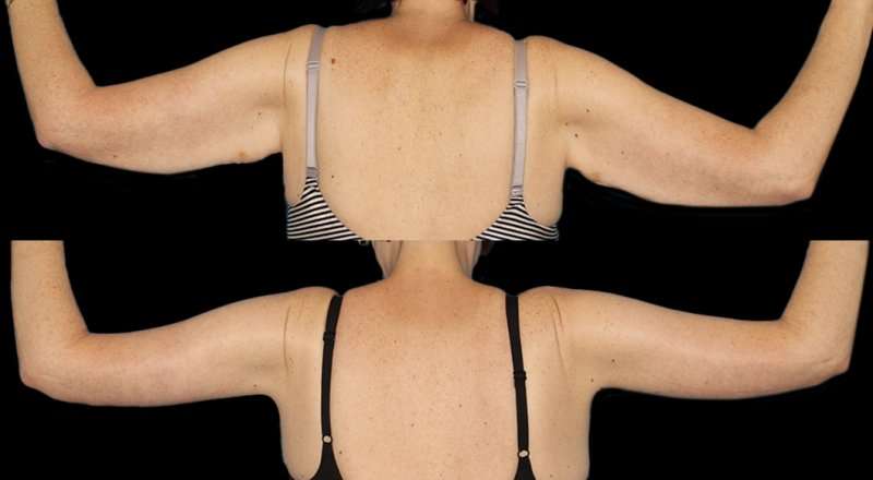 Brachioplasty (Arm Lift) Before & After Patient #1131