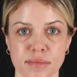 Chemical Peels Before & After Patient #5601