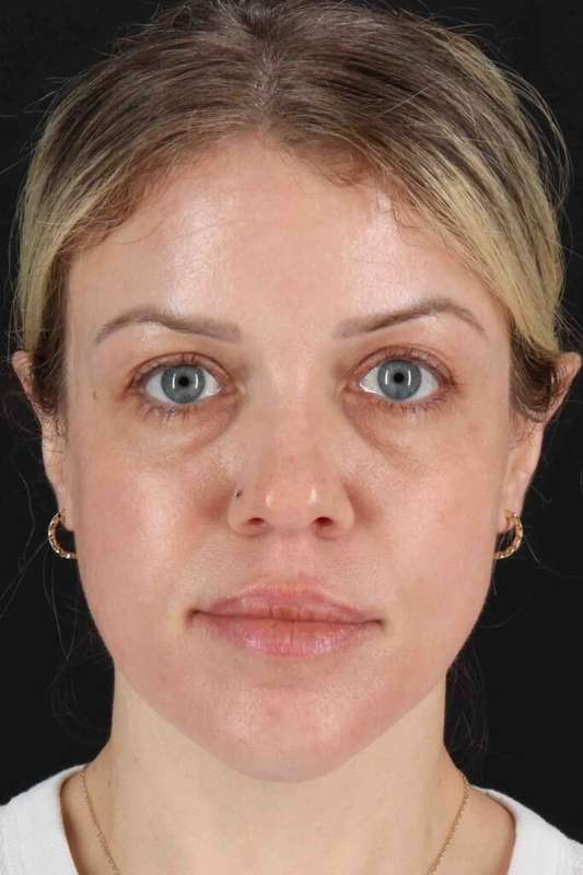 Chemical Peels Before & After Patient #5601