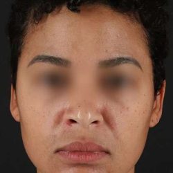 Chemical Peels Before & After Patient #5610
