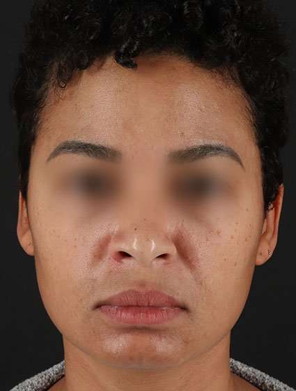 Chemical Peels Before & After Patient #5610