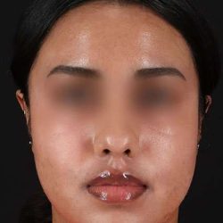 Chemical Peels Before & After Patient #5621
